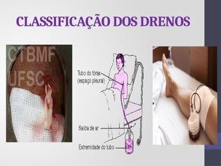 CLASSIFICAÇÃO DOS DRENOS
 