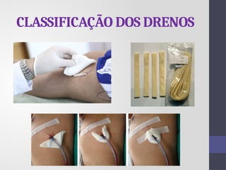 CLASSIFICAÇÃO DOS DRENOS
 
