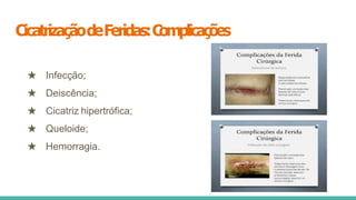CicatrizaçãodeFeridas:C
omplicações
★ Infecção;
★ Deiscência;
★ Cicatriz hipertrófica;
★ Queloide;
★ Hemorragia.
 