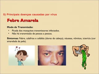 5) Principais doenças causadas por vírus
Febre AmarelaFebre Amarela
Modo de Transmissão:
• Picada dos mosquitos transmissores infectados.
• Não há transmissão de pessoa a pessoa.
Sintomas: Febre, calafrios e cefaléia (dores de cabeça), náuseas, vômitos, icterícia (cor
amarelada da pele).
 