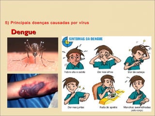 5) Principais doenças causadas por vírus
DengueDengue
 