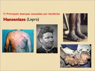 7) Principais doenças causadas por bactérias
HanseníaseHanseníase (Lepra)
 