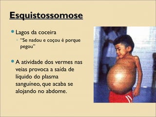 EsquistossomoseEsquistossomose
Lagos da coceira
◦ “Se nadou e coçou é porque
pegou”
A atividade dos vermes nas
veias provoca a saída de
líquido do plasma
sanguíneo, que acaba se
alojando no abdome.
 