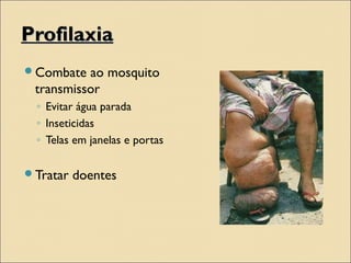 ProfilaxiaProfilaxia
Combate ao mosquito
transmissor
◦ Evitar água parada
◦ Inseticidas
◦ Telas em janelas e portas
Tratar doentes
 