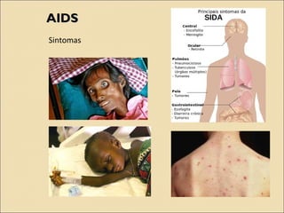AIDSAIDS
Sintomas
 