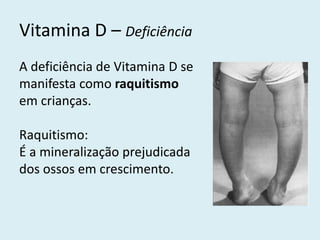 A deficiência de Vitamina D se manifesta como raquitismo em crianças. 
Raquitismo: 
É a mineralização prejudicada dos ossos em crescimento. 
Vitamina D – Deficiência  