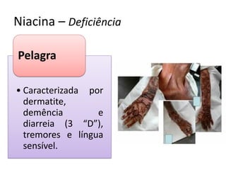 Niacina – Deficiência 
•Caracterizada por dermatite, demência e diarreia (3 “D”), tremores e língua sensível. 
Pelagra  