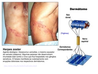 (Trigêmeo)
Dermátomo
Dermátomos
Correspondentes
Herpes zoster
Agente etiológico: Herpesvirus varicellae, o mesmo causador
da varicela (catapora). Algumas pessoas não desenvolvem
imunidade total contra o vírus que fica hospedado nos gânglios
sensitivos. O herpes manifesta-se cutaneamente com
erupções dolorosas nos respectivos dermátomos.
http://users.wfu.edu/butlrs4/cell/index.html
 