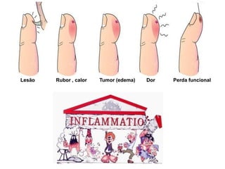 Lesão Rubor , calor Tumor (edema) Dor Perda funcional
 