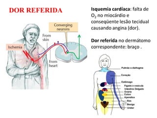 Isquemia cardíaca: falta de
O2 no miocárdio e
conseqüente lesão tecidual
causando angina (dor).
Dor referida no dermátomo
correspondente: braço .
DOR REFERIDA
 