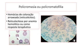 Policromasia ou policromatofilia
• Hemácias de coloração
arroxeada (reticulócitos).
• Reticulocitose por anemia
hemolítica ou como
resposta terapêutica
 