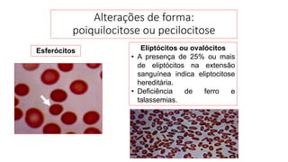 Alterações de forma:
poiquilocitose ou pecilocitose
Eliptócitos ou ovalócitos
• A presença de 25% ou mais
de eliptócitos na extensão
sanguínea indica eliptocitose
hereditária.
• Deficiência de ferro e
talassemias.
Esferócitos
 