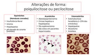 Equinócitos
(Hemáceas crenadas)
• Insuficiência Renal
• Uremia
• Hepatopatias
• pH elevado do corante
(artefato)
Alterações de forma:
poiquilocitose ou pecilocitose
Acantócitos
• Abetalipoproteinemia
• Cirrose hepática e
hepatopatias
• Pós esplenectomia
• São vistos em pacientes
heparinizados
Estomatócitos
• Estomatocitose
hereditária (> 25% dos
eritrócitos)
• Hepatopatias
• Alcoolismo
• Artefatos
 