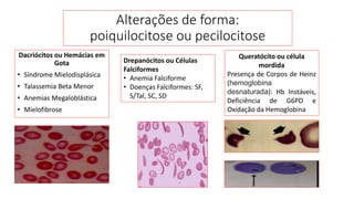 Dacriócitos ou Hemácias em
Gota
• Síndrome Mielodisplásica
• Talassemia Beta Menor
• Anemias Megaloblástica
• Mielofibrose
Alterações de forma:
poiquilocitose ou pecilocitose
Drepanócitos ou Células
Falciformes
• Anemia Falciforme
• Doenças Falciformes: SF,
S/Tal, SC, SD
Queratócito ou célula
mordida
Presença de Corpos de Heinz
(hemoglobina
desnaturada): Hb Instáveis,
Deficiência de G6PD e
Oxidação da Hemoglobina
 