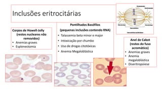 Inclusões eritrocitárias
Pontilhados Basófilos
(pequenas inclusões contendo RNA)
• Talassemia beta minor e major
• Intoxicação por chumbo
• Uso de drogas citotóxicas
• Anemia Megaloblástica
Corpos de Howell-Jolly
(restos nucleares não
removidos)
• Anemias graves
• Esplenectomia
Anel de Cabot
(restos do fuso
acromático)
• Anemias graves
• Anemia
megaloblástica
• Diseritropoiese
 