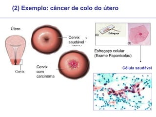(2) Exemplo: câncer de colo do útero
Útero
Cervix
saudável
Cervix
com
carcinoma
Esfregaço celular
(Exame Papanicolau)
Célula saudável
 