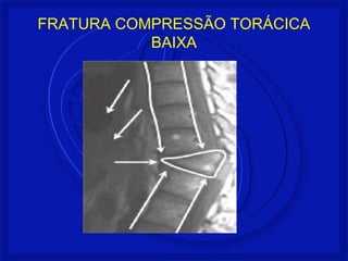 FRATURA COMPRESSÃO TORÁCICA 
BAIXA 
 