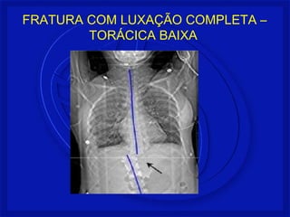 FRATURA COM LUXAÇÃO COMPLETA – 
TORÁCICA BAIXA 
 
