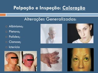 Palpação e Inspeção: Coloração
Alterações Generalizadas:
 Albinismo;
 Pletora;
 Palidez;
 Cianose;
 Icterícia
 