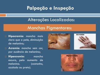 Palpação e Inspeção
 Hipocromia: mancha mais
clara que a pele, diminuição
de melanina;
 Acromia: mancha sem cor,
por ausência de melanina;
 Hipercromia: mancha
escura, pelo aumento de
melanina. (castanho,
azulado ou preto).
Manchas Pigmentares:
Alterações Localizadas:
 