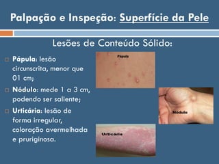 Palpação e Inspeção: Superfície da Pele
 Pápula: lesão
circunscrita, menor que
01 cm;
 Nódulo: mede 1 a 3 cm,
podendo ser saliente;
 Urticária: lesão de
forma irregular,
coloração avermelhada
e pruriginosa.
Lesões de Conteúdo Sólido:
 