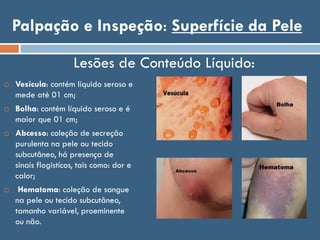 Palpação e Inspeção: Superfície da Pele
 Vesícula: contém líquido seroso e
mede até 01 cm;
 Bolha: contém líquido seroso e é
maior que 01 cm;
 Abcesso: coleção de secreção
purulenta na pele ou tecido
subcutâneo, há presença de
sinais flogistícos, tais como: dor e
calor;
 Hematoma: coleção de sangue
na pele ou tecido subcutâneo,
tamanho variável, proeminente
ou não.
Lesões de Conteúdo Líquido:
 