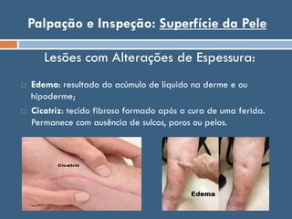 Palpação e Inspeção: Superfície da Pele
 Edema: resultado do acúmulo de líquido na derme e ou
hipoderme;
 Cicatriz: tecido fibroso formado após a cura de uma ferida.
Permanece com ausência de sulcos, poros ou pelos.
Lesões com Alterações de Espessura:
 