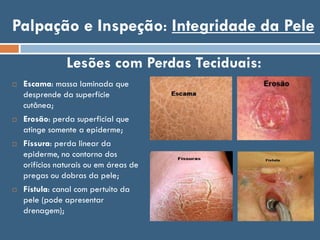 Palpação e Inspeção: Integridade da Pele
 Escama: massa laminada que
desprende da superfície
cutânea;
 Erosão: perda superficial que
atinge somente a epiderme;
 Físsura: perda linear da
epiderme, no contorno dos
orifícios naturais ou em áreas de
pregas ou dobras da pele;
 Fístula: canal com pertuito da
pele (pode apresentar
drenagem);
Lesões com Perdas Teciduais:
 