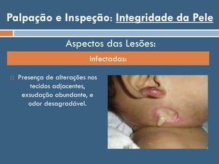 Palpação e Inspeção: Integridade da Pele
 Presença de alterações nos
tecidos adjacentes,
exsudação abundante, e
odor desagradável.
Aspectos das Lesões:
Infectadas:
 