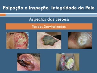 Palpação e Inspeção: Integridade da Pele
Aspectos das Lesões:
Tecidos Desvitalizados:
 