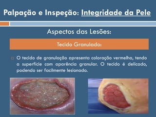 Palpação e Inspeção: Integridade da Pele
Tecido Granulado:
Aspectos das Lesões:
 O tecido de granulação apresenta coloração vermelha, tendo
a superfície com aparência granular. O tecido é delicado,
podendo ser facilmente lesionado.
 