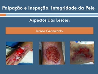 Palpação e Inspeção: Integridade da Pele
Tecido Granulado:
Aspectos das Lesões:
 