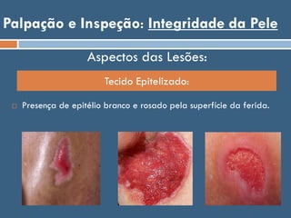 Palpação e Inspeção: Integridade da Pele
Tecido Epitelizado:
Aspectos das Lesões:
 Presença de epitélio branco e rosado pela superfície da ferida.
 