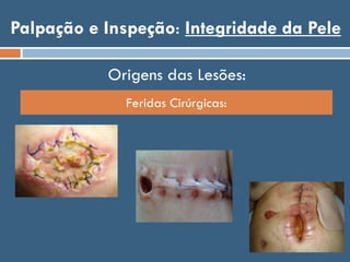 Palpação e Inspeção: Integridade da Pele
Feridas Cirúrgicas:
Origens das Lesões:
 