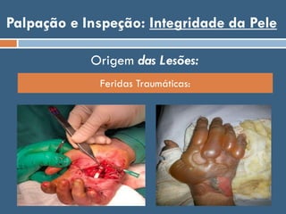 Palpação e Inspeção: Integridade da Pele
Origem das Lesões:
Feridas Traumáticas:
 