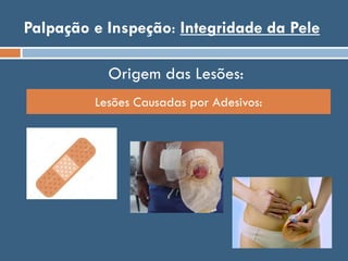 Palpação e Inspeção: Integridade da Pele
Origem das Lesões:
Lesões Causadas por Adesivos:
 