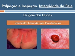 Palpação e Inspeção: Integridade da Pele
Origem das Lesões:
Dermatites Causadas por Incontinências:
 
