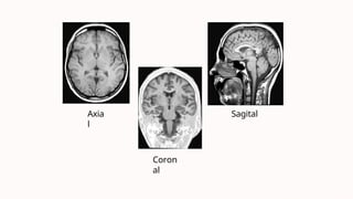 Axia
l
Coron
al
Sagital
 