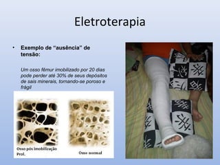 Eletroterapia
• Exemplo de “ausência” de
tensão:
Um osso fêmur imobilizado por 20 dias
pode perder até 30% de seus depósitos
de sais minerais, tornando-se poroso e
frágil
 