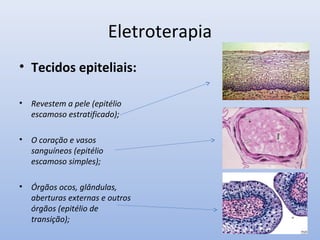 Eletroterapia
• Tecidos epiteliais:
• Revestem a pele (epitélio
escamoso estratificado);
• O coração e vasos
sanguíneos (epitélio
escamoso simples);
• Órgãos ocos, glândulas,
aberturas externas e outros
órgãos (epitélio de
transição);
 
