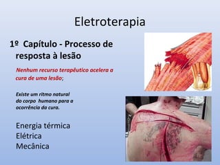 Eletroterapia
1º Capítulo - Processo de
resposta à lesão
Nenhum recurso terapêutico acelera a
cura de uma lesão;
Existe um ritmo natural
do corpo humano para a
ocorrência da cura.
Energia térmica
Elétrica
Mecânica
 