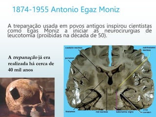 1874-1955 Antonio Egaz Moniz
A trepanação usada em povos antigos inspirou cientistas
como Egas Moniz a iniciar as neurocirurgias de
leucotomia (proibidas na década de 50).
A trepanação já era
realizada há cerca de
40 mil anos
 