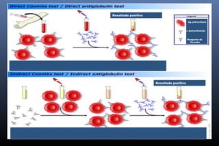 Resultado positivo
Resultado positivo
Ag eritrocitário
Ac Anti-eritrócito
Reagente de
Coombs
 