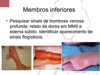 Membros inferiores
• Pesquisar sinais de trombose venosa
profunda: relato de dores em MMII e
edema súbito. Identificar aparecimento de
sinais flogísticos.
 