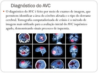 Diagnóstico do AVC
 O diagnóstico do AVC é feito por meio de exames de imagem, que
permitem identificar a área do cérebro afetada e o tipo do derrame
cerebral.Tomografia computadorizada de crânio é o método de
imagem mais utilizado para a avaliação inicial do AVC isquêmico
agudo, demonstrando sinais precoces de isquemia.
 