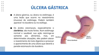 ÚLCERA GÁSTRICA
● A úlcera gástrica, ou úlcera no estômago, é
uma lesão que ocorre no revestimento
(mucosa) do estômago. Podem também
aparecer no duodeno ou no esófago.
● Os ácidos estomacais, especialmente o
clorídrico, são muito fortes. Num estômago
normal e saudável, sua ação restringe-se
somente aos alimentos, mas, em
determinadas situações, eles podem atacar
o revestimento do trato digestivo e provocar
o aparecimento de uma úlcera que destrói a
parede estomacal e do duodeno.
 