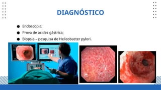 DIAGNÓSTICO
● Endoscopia;
● Prova de acidez gástrica;
● Biopsia – pesquisa de Helicobacter pylori.
 