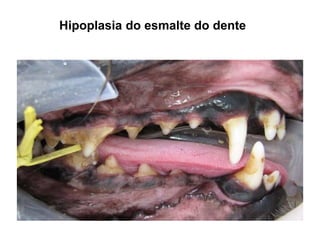 Hipoplasia do esmalte do dente
 