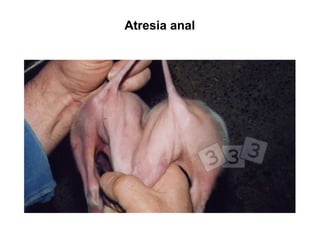 Atresia anal
 