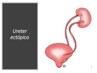 Ureter
ectópico
 